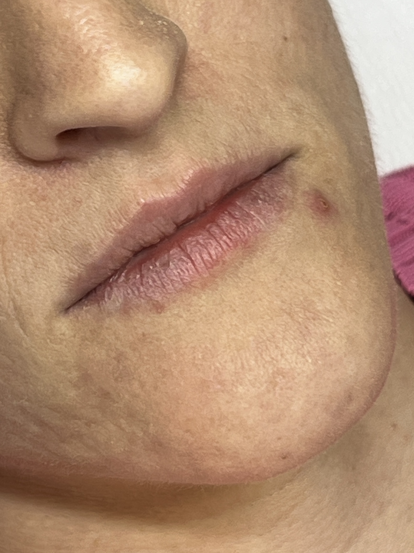 Bia antes do preenchimento labial